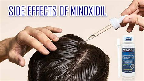 The 5 Minoxidil Side Effects You Should Know .